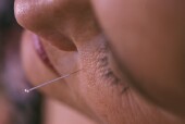 acupuncture