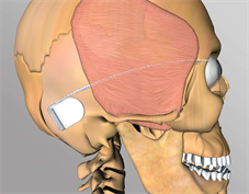 electronic retinal implant