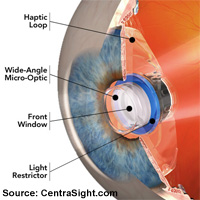 Alpha IMS wireless implant