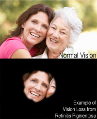 Retinitis Pigmentosa vision loss example