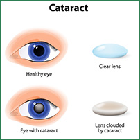 cataract surgery lens replacement
