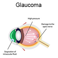 glaucoma explanation