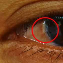 pterygium