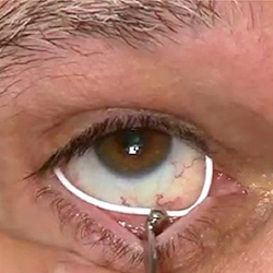 Bimatoprost ring