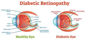 diabetic retinopathy diagram