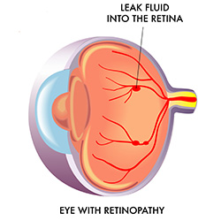 retinal bleeding from diabetic retinopathy or macular degeneration