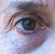dark-circles