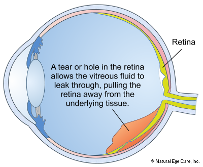 retinal-detachment