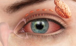 dry-eyes