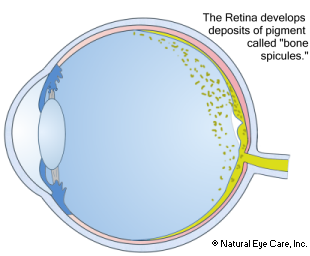 retinitis-pigmentosa