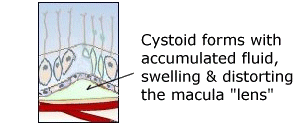 cystoid