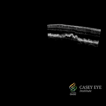 Video of an optical coherence tomography (OCT) scan